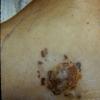 Satillite Melanoma