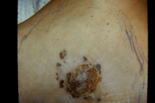 Satillite Melanoma