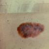 Superficial Spreading Malignant Melanoma