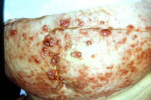 Carcinomatosis (3)