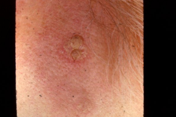 Squamous Cell Carcinoma (3)