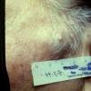 Lymph Angioma