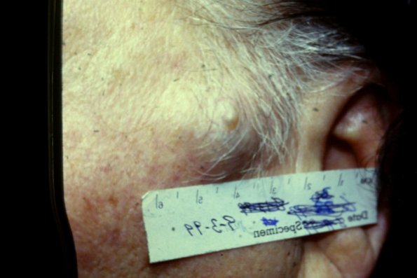 Lymph Angioma