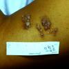 Lymphangioma (2)
