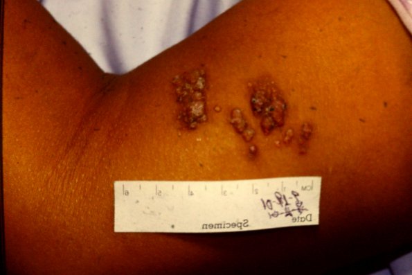 Lymphangioma (3)