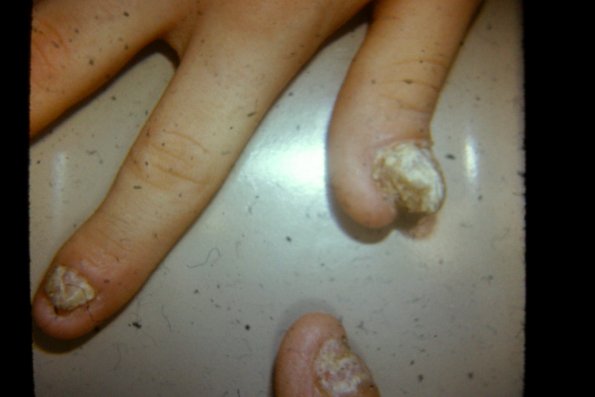 Mucocutaneous Candidiasis