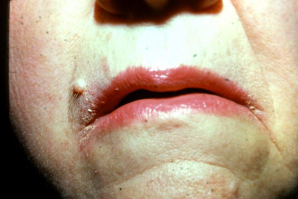 Angular Cheilitis (2)