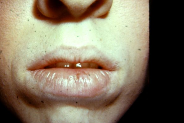 Cheilitis (2)