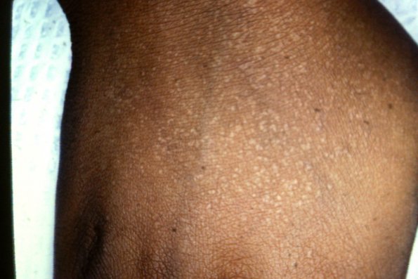 Darier's Disease (6)