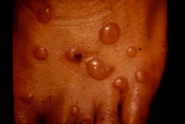 Dermatitis Herpetiformis (22)
