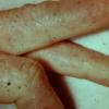 Contact Dermatitis (10)