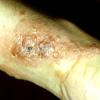 Contact Dermatitis (4)