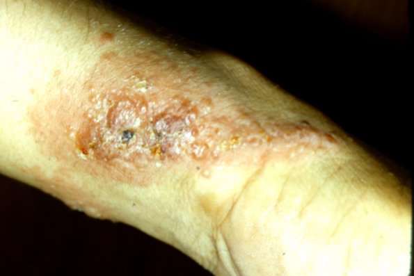 Contact Dermatitis (4)