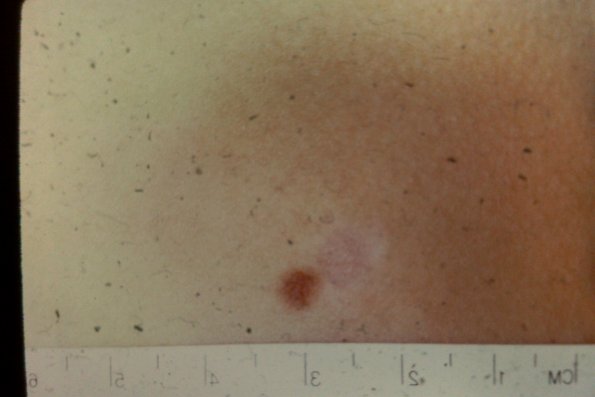 DermatofibroSarcoma (3)