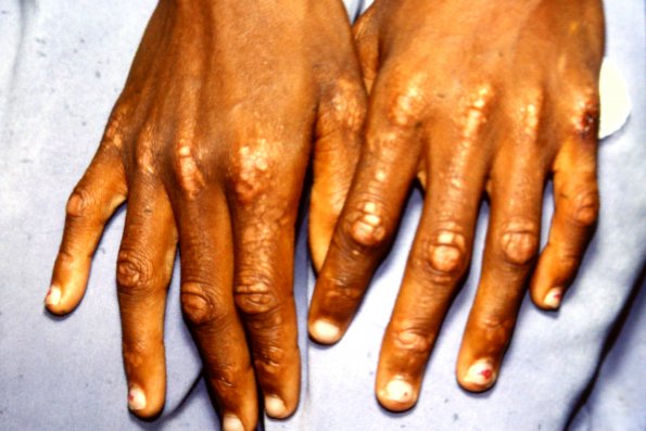 Dermatomyositis (4)