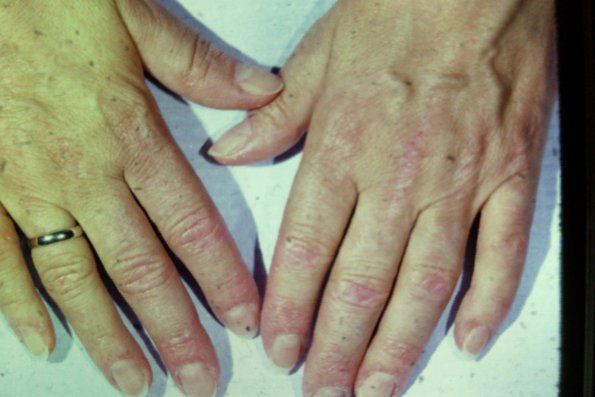 Dermatomyositis (5)