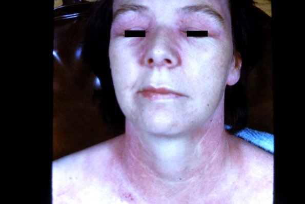 Dermatomyositis