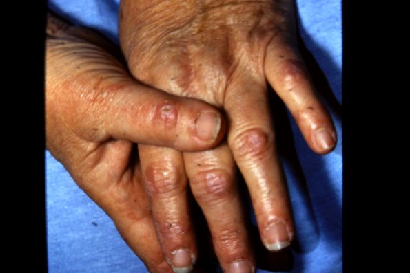 dermatomyositis Gottrans Papules