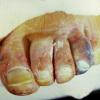 Diabetic Gangrene