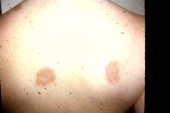 Necrobiosis Lipoidica Diabeticurum (2)