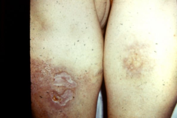 Necrobiosis Lipoidica Diabeticurum (4)