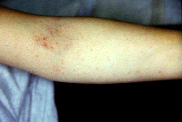 Atopic Dermatitis