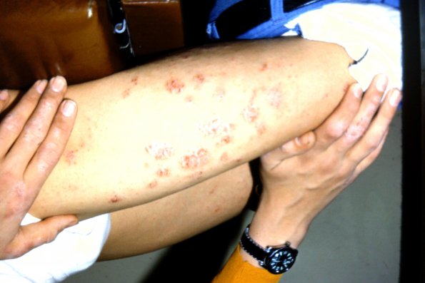 Nammalar Eczema (2)