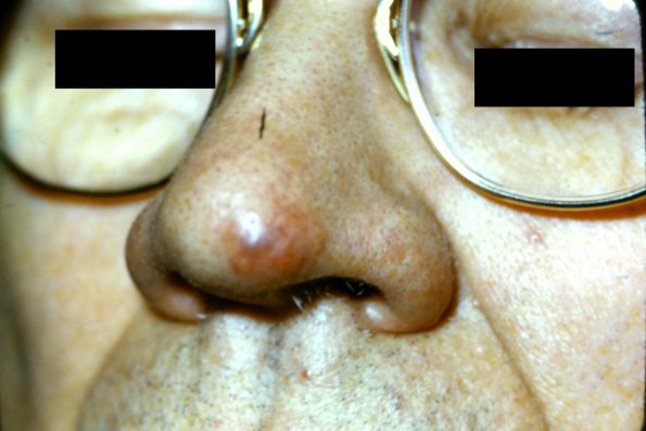 Eosinophilic Granuloma