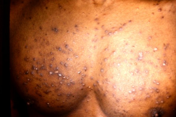 Eosinophilic Pustular Folliculitis