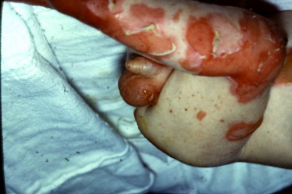 Epidermolysis Bullosa (14)