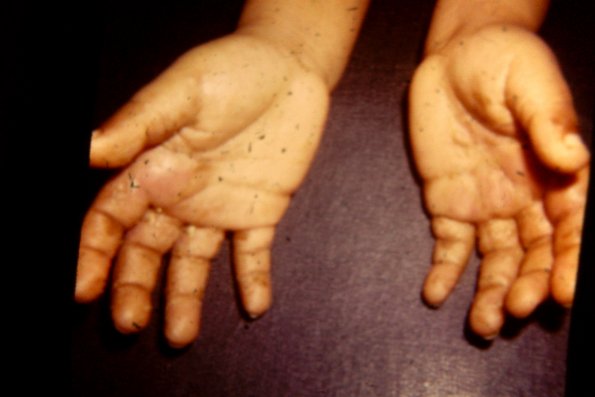 Epidermolysis Bullosa (16)