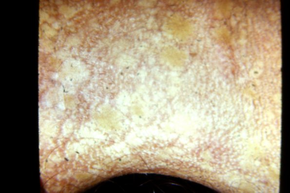 Epidermolysis Bullosa (23)