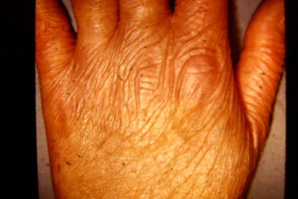 Epidermolysis Bullosa (24)