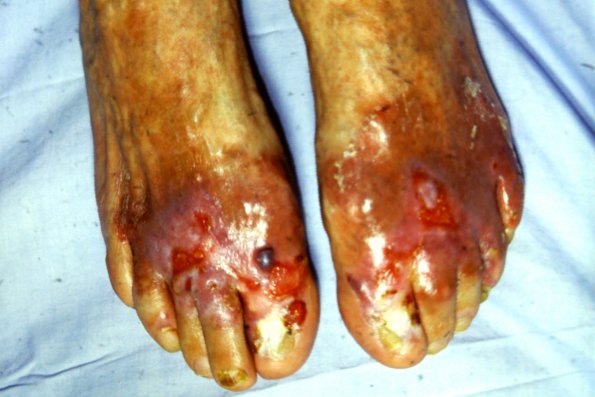 Epidermolysis Bullosa (29)