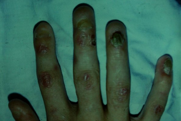 Epidermolysis Bullosa (5)