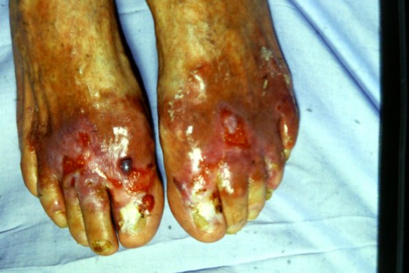 Epidermolysis Bullosa (7)