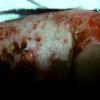 Epidermolysis Bullosa Letalis (2)