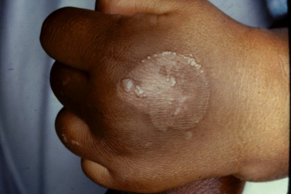 Epidermolysis Bullosa Simplex (2)