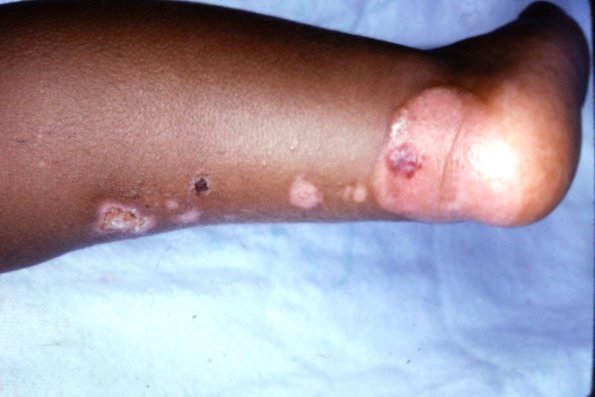 Epidermolysis Bullosa Simplex