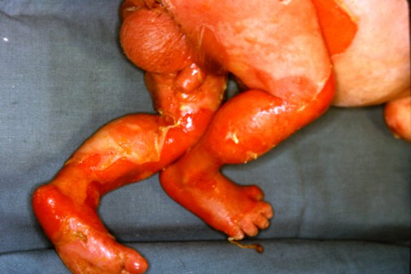 Epidermolysis bullosa letalis