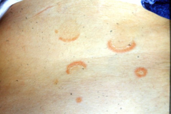 Erythema Annulare