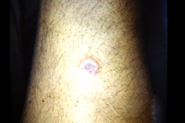 Bullous Erythema Multiforme (3)