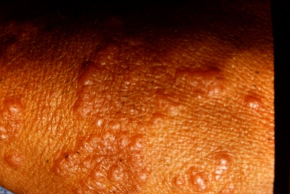 Erythema Exodantium Multiforme