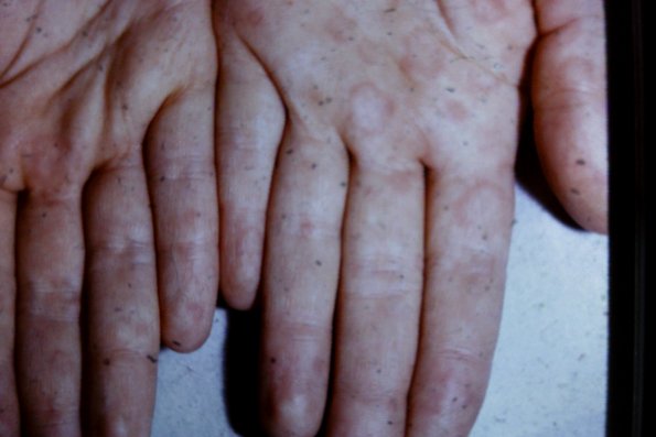 Erythema Multiforme (11)