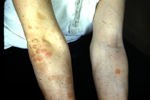 Erythema Multiforme (17)