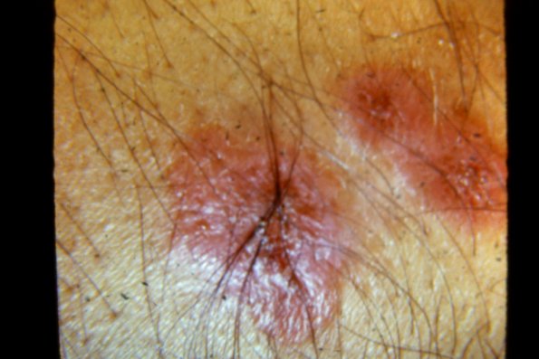 Erythema Multiforme (21)