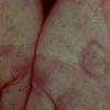 Erythema Multiforme (25)