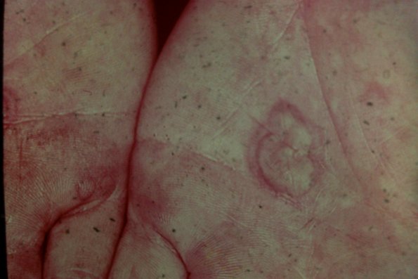 Erythema Multiforme (25)