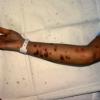 Erythema Multiforme (26)