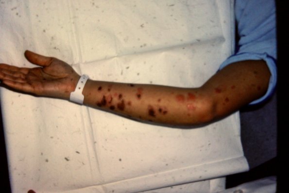 Erythema Multiforme (26)